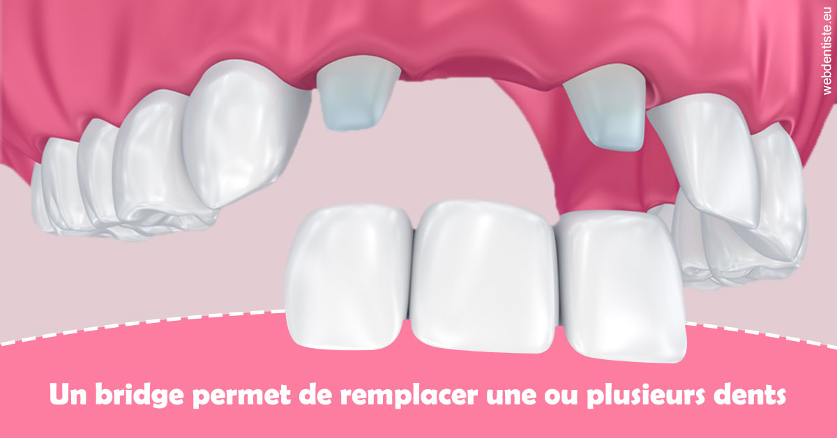 https://www.orthodontie-monthey.ch/Bridge remplacer dents 2