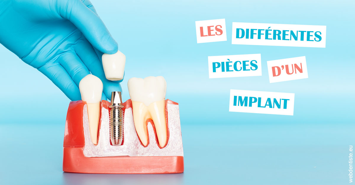 https://www.orthodontie-monthey.ch/Les différentes pièces d’un implant 2