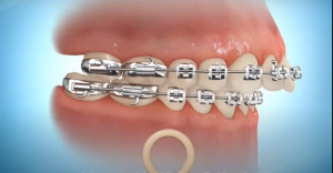 Les élastiques en orthodontie - Class II